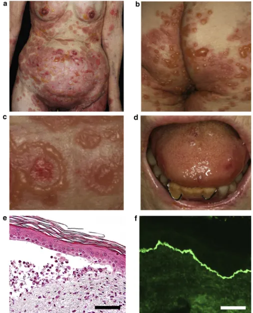 Figure 1. Clinical, histopathological, and immunological features of a typical patient with  vancomycin-induced linear IgA bullous
