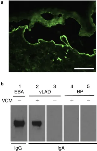 Figure 3. Identifying the target antigen of IgA autoantibody in vLAD. (a) The vLAD serum with 0.5 m g/ml VCM showed binding of IgA to the dermal side in indirect immunofluorescence using 1 mol/L NaCl-split skin