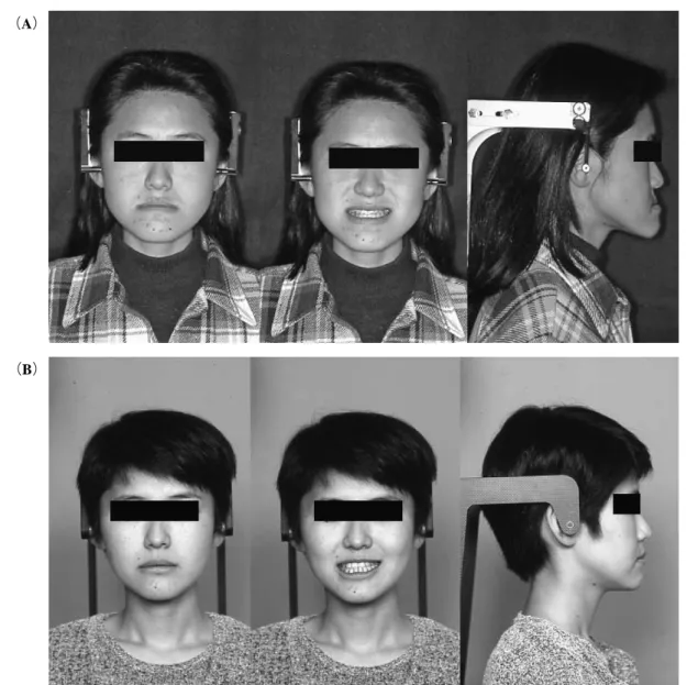 Fig 1 Facial views. （A）pre-treatment,（B ）post-treatment.