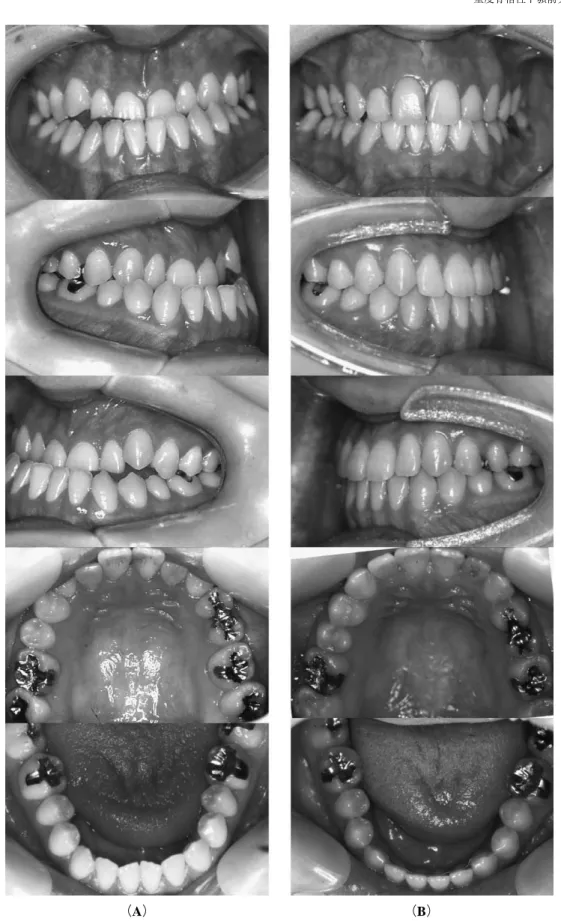 Fig 2 Intra oral views. （A）pre-treatment,（B ）post-treatment.