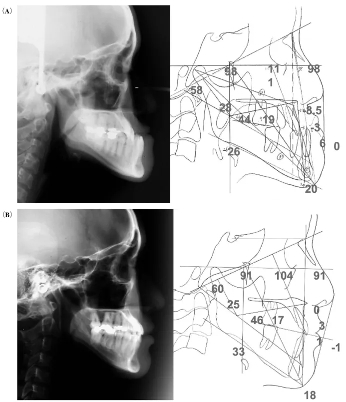 Fig 5 Lateral cephalograms. （A）pre-treatment,（B ）post-treatment.