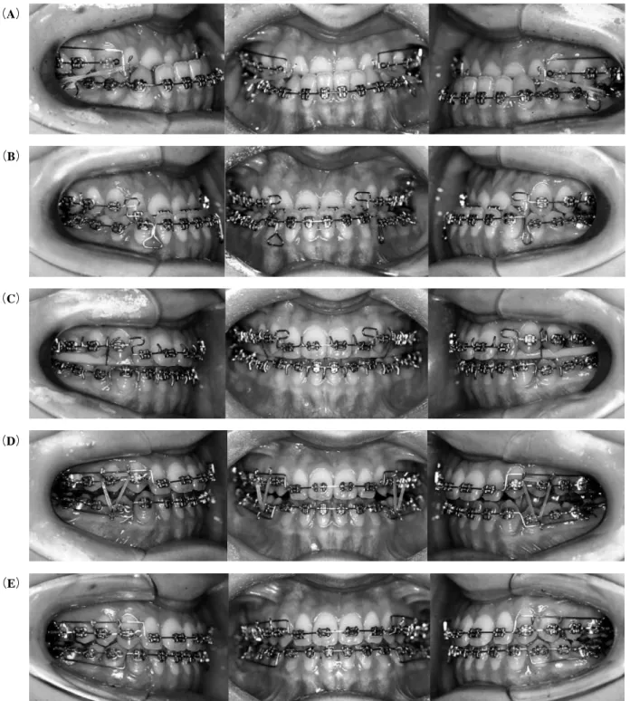Fig 6 Intra oral views. （A）with a sectional arch in maxillary arch,（B ）just before operation,（C ）after operation,（D ）mono
