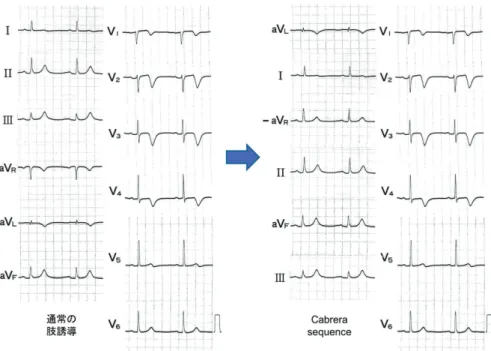 図 4　急性冠症候群の心電図 左前下行枝近位部に 90％狭窄を認めた急性冠症候群の心電図．陰性 T 波は，前胸部誘導では V2-4 誘導を中心に，肢誘導で は上位側壁に面する aVL 誘導で認める．陰性 T 波の分布は，虚血責任血管である左前下行枝の灌流域を反映すると考えら れる． 図 5　急性肺塞栓症の心電図 右心不全を合併した重症急性肺塞栓症の心電図．陰性 T 波は，前胸部誘導では V1-3 誘導を中心に V4 誘導まで認める．肢誘 導の陰性 T 波は，通常の配列だと連続性がなく分かりにくいが，Cabr