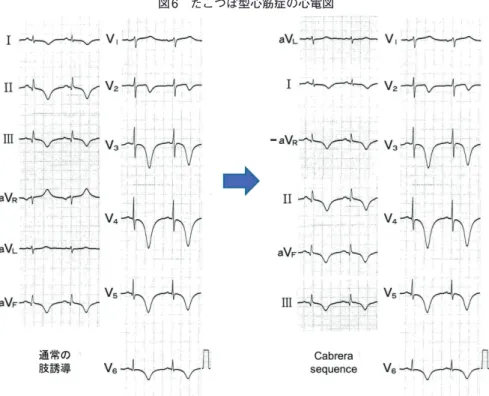 図 6　たこつぼ型心筋症の心電図