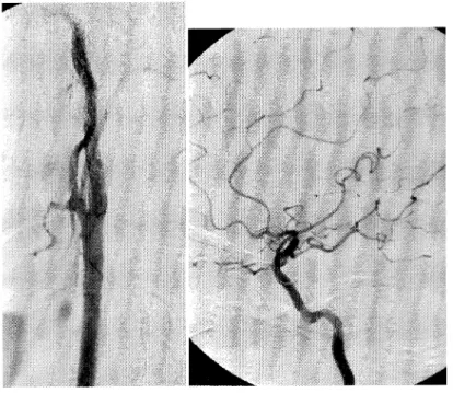 Fig.  1  The first left carotid  arteriogram demonstrated  that the  ICA appeared  normal at  the cervical  portion (A) through  the  intracranial part,   how-ever  an  embolic  occlusion  of the  anterior  ascending  branch  of  the  left MCA  (B).