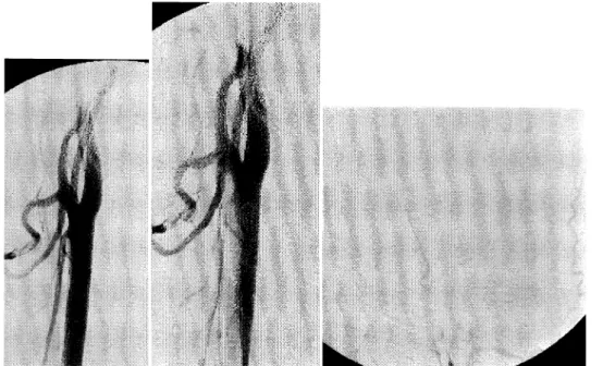 Fig. 4  Collateral  circulation  to  the  left cerebral  hemisphere  were  through  the  left anterior  cerebral  arteries  (A), the  left posterior cerebral  arteries  and  the  posterior  communi-cating  artery  (B).