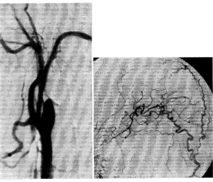 Fig. 5  Angiograpms  taken  8  months postoperatively  showed  a  com- com-plete  occlusion  of  the  cervical  ICA (A)  and  a  patent   anasto-mosis  between  the  occipital  and  the  middle  cerebral  artery  (B).