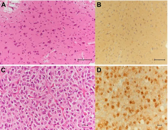 Fig. 2 Histological findings from brain biopsy specimens of the frontal cortex (A, B) and the ring-enhancing area in the white matter (C, D)