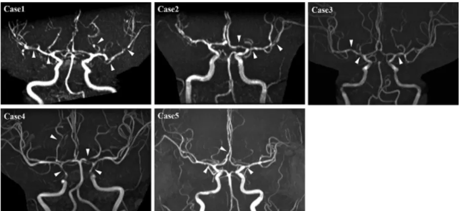Fig. 2  MRA images for all cases performed day 2 to 7 after oneset. MRA images for cases 1 to 5 revealed multiple focal vasoconstrictions, which are  char-acteristic of RCVS (arrow)