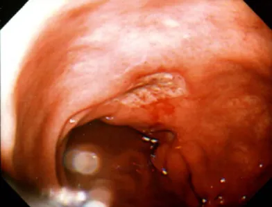 図 1.ロキソプロフェンナトリウムによる急性胃潰瘍 