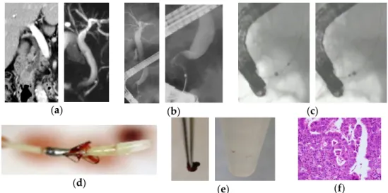 Figure 1. A case of bile duct stricture diagnosed as distal cholangiocarcinoma with an endoscopic  scraper (Trefle ® )