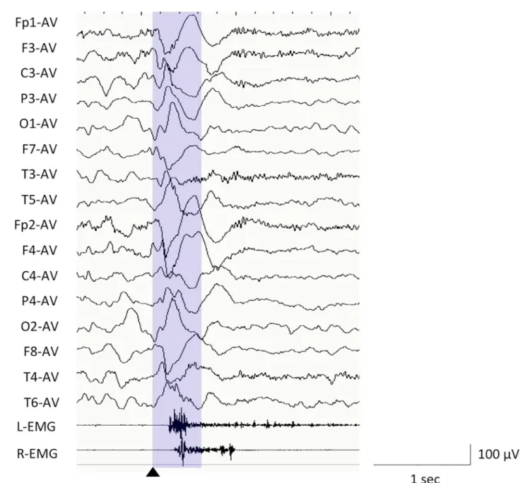 FIGURE 1 | Electroencephalography (EEG) example of epileptic spasms in monopolar montages of average reference and EEG analysis window