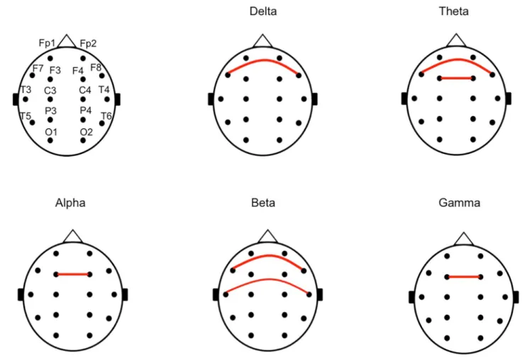 FIGURE 3 | The chart of a pair of symmetrical electrodes with large phase lags in the unfavorable outcome group