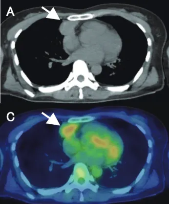 Fig. 5.  A 49-year-old female with thymic carcinoma (Masaoka  stage  Ⅲ ). CT, PET and fusion images show strong FDG uptake  in anterior mediastinal tumor (arrows)