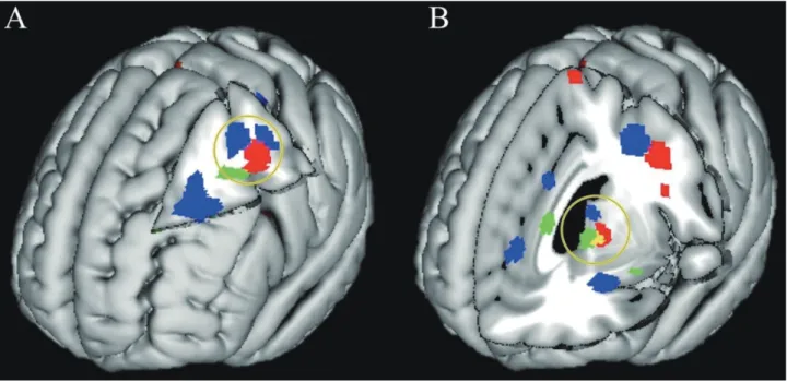 Fig. 2.  Cognitive remediation (CR)-elicited changes in brain activation showing that CR training supports restorative functioning in pre- pre-frontal and thalamic areas (with permission of Oxford University Press provided February 19, 2018) 