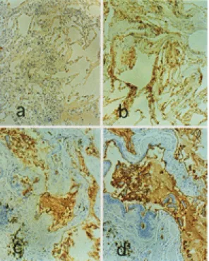 Fig. 4.  a, b: Transbronchial lung biopsy speci- speci-men in January 1992. c, d: Necropsy specispeci-men in February 1996.