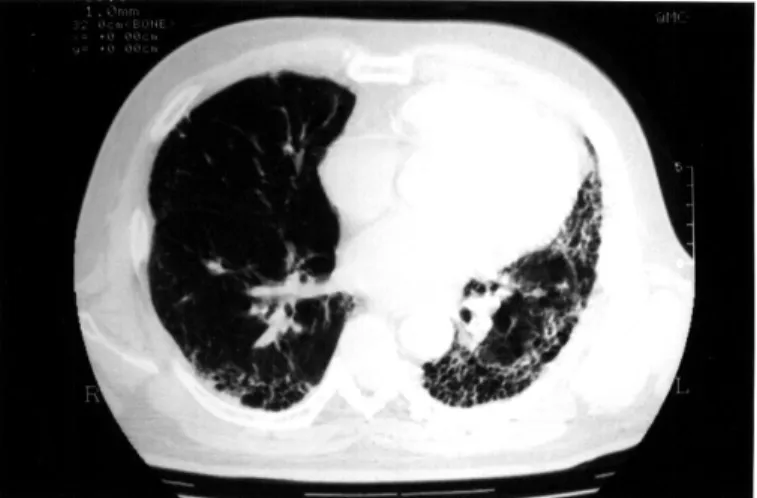 Fig. 1.  Computed tomography of the chest in case 1.