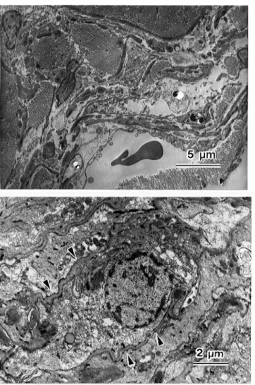 Fig. 2 (upper). Abnormal epithelial proliferation is seen inside the anterior lens capsule.