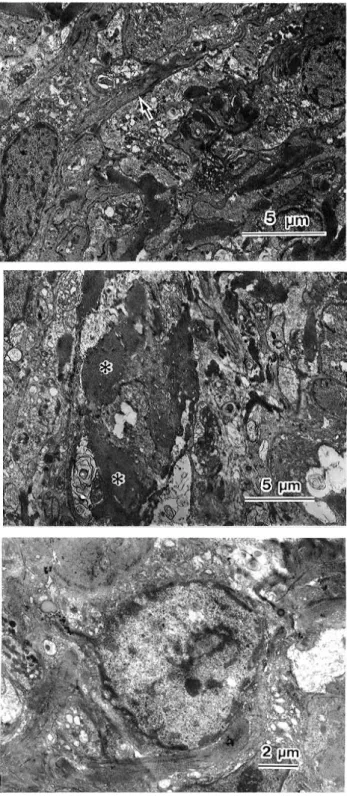 Fig. 4 ( upper). A spindle-shaped lens epithelial cell (arrow) stretches like a pseudopodium.