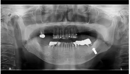 Fig. 3　パノラマX線撮影．左下第7に根尖性歯周炎を認める．