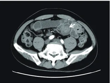 Fig. 2.  Endoscopic image of the tumor. Enteroscopy revealed a  3-cm submucosal tumor at the ileum.
