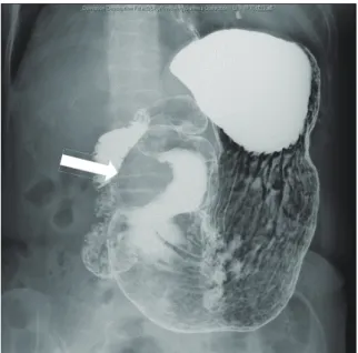 Fig. 1.  Upper gastrointestinal X-ray showing the smooth-margin- smooth-margin-ated protruded lesion at the greater curvature of the antrum of the  stomach (arrow).