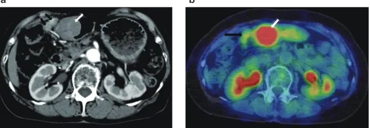 Fig. 3.  CT image.  a : CT image showing a protruded lesion measuring 45 × 37 mm at the antrum of the stomach (white arrow), and en- en-largement of the regional lymph nodes of the stomach (black arrow)