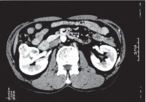 Fig. 1.  Early-phase enhanced computed tomogram demonstrating a renal tumor in the right kidney (case 1).