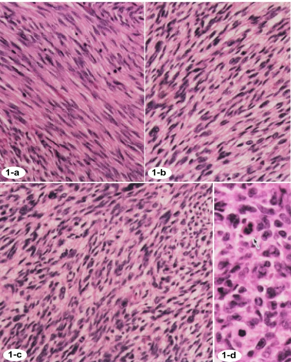 Fig. 1. Histological findings of LMS.  Hematoxylin and eosin stain,  ×  200.