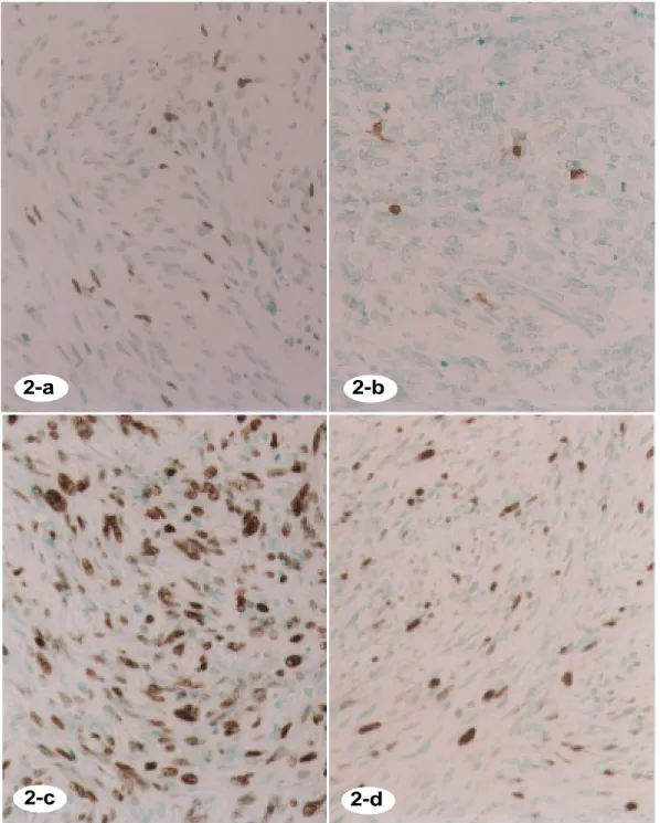 Fig. 2c.  Immunohistochemical stain of p53 protein.  Strongly positive for the tumor cell nuclei