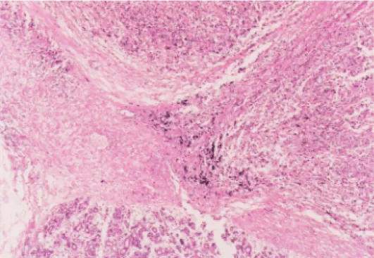 Fig. 2.  The tumor cells show a solid, trabecular or alveolar pattern.  Hematoxylin and eosin, × 40.