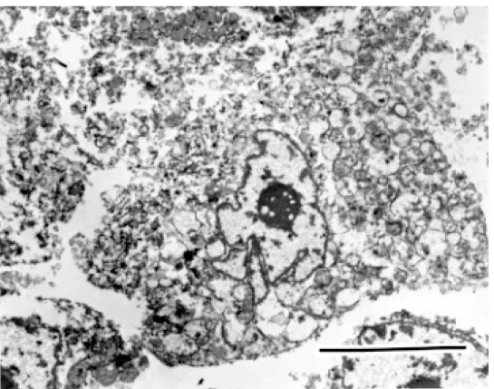 Fig. 4.  Ultrastructure features of the tumor cells. The tumor cell is rich in mitochondria