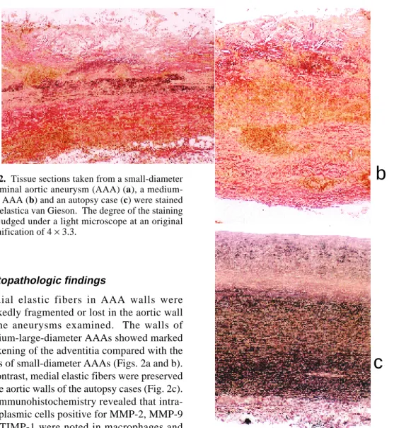 Fig. 2.  Tissue sections taken from a small-diameter abdominal aortic aneurysm (AAA) (a), a  medium-large AAA (b) and an autopsy case (c) were stained with elastica van Gieson