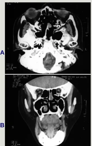 Fig. 1.  Computerized tomography sections of axial (A) and coronal (B) views of the tumor (arrows) seen in the left nasal cavity.