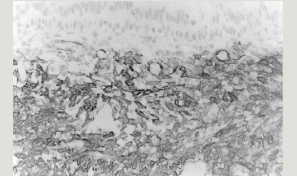 Fig. 4.  The tumor cells were diffusely positive for alpha smooth muscle actin. Immunostaining for alpha smooth muscle actin (original magnification ×  200).