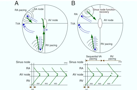 Fig. 1.  Illustrations showing the method of sequential ventriculo-atrial (VA) and right ventricular (RV) pacings, with the conduction patterns during sequential VA pacing (A) and during RV pacing (B)