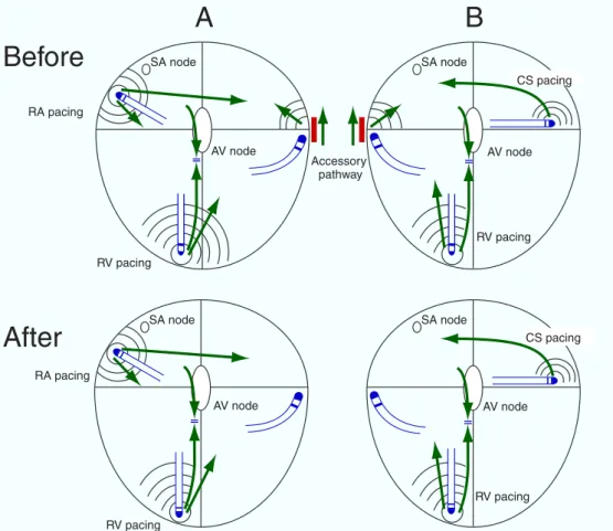 Fig. 2 .  Illustration showing the activation sequences before and after the elimination of accessory pathway conduction when sequential ventriculo-high right atrium pacing ( A ) or ventriculo-coronary sinus (CS) pacing ( B ) is applied during the radiofre