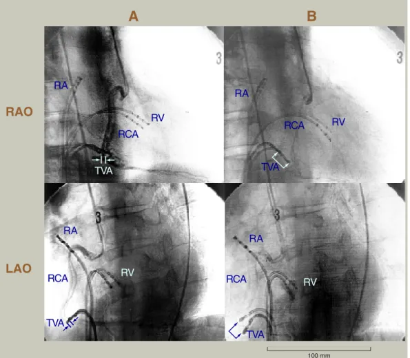 Fig. 5.   The fluoroscopy images of the right coronary artery angiogram in the 30˚ right anterior oblique (RAO) and 45˚ left anterior oblique (LAO) projections during sequential ventriculo-atrial pacing ( A ) and right ventricular pacing when a fusion beat