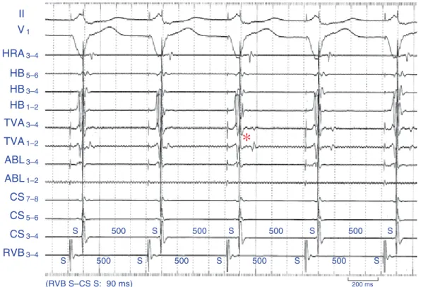 Fig. 7.   Surface electrocardiographic (ECG) tracings and intracardiac electrograms recorded during radiofrequency (RF) catheter ablation of a concealed right lateral accessory pathway during  ventriculo-coronary sinus (VCS) pacing