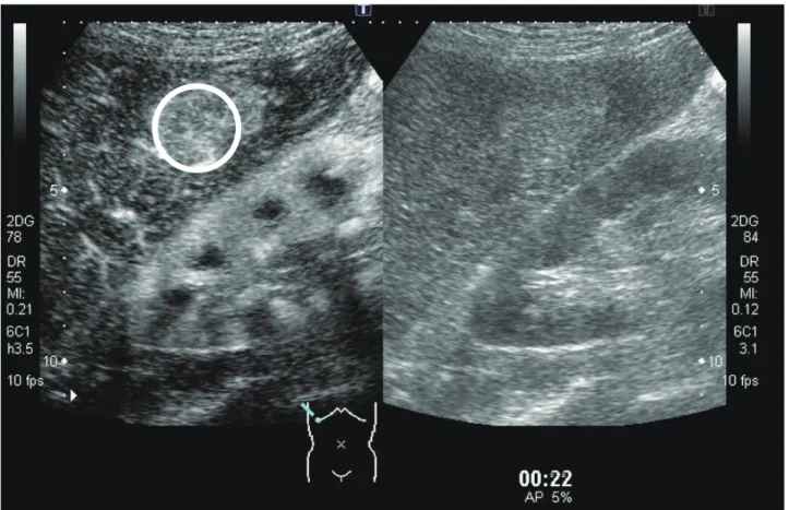 Fig. 1.  ROI of the tumor. Circle indicates the ROI. Right image: B-mode. Left image: CEUS-mode