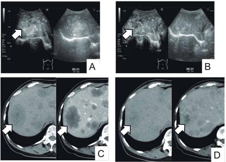 Fig. 3.  Several images of a case of partial response to chemotherapy. Arrows indicate the tumor
