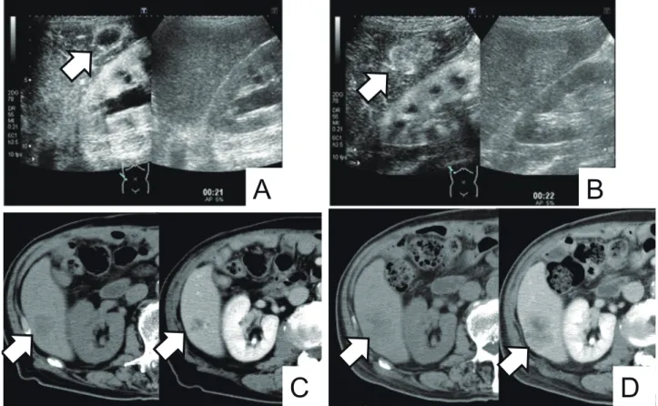 Fig. 5.  Several images of a case of progressive disease after chemotherapy. Arrows indicate the tumor