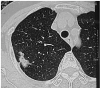 Fig. 2.  Autopsy findings show many embolisms (arrows) blocking bilateral main pulmonary arteries to the periphery