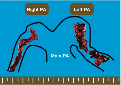 Fig. 3.  The resected were fresh red embolisms 55   7 mm in size on the right  side and 60   13 mm on the left