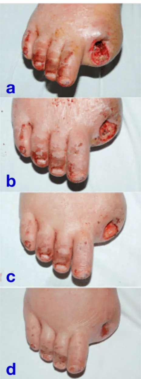 Fig.  4.    Effect  of  the  Vacuum-Assisted  Closure  (VAC)  Therapy  for  the  right  leg
