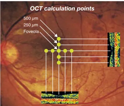 Fig. 3.  Calculation points on optical coherence tomogram (OCT).  The mean retinal thickness was estimated from  9 calculation points at the foveal region within 5 degrees; the central and each of the other 4 points at a distance of  250 µm and 500 µm from