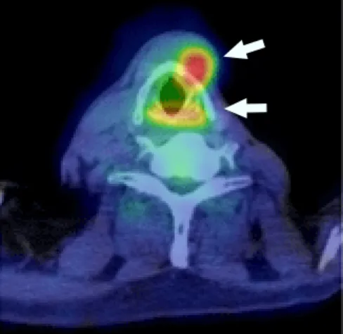 Fig. 4.  Hypopharyngeal cancer localized to the right py- py-riform sinus reconstructed with the 1.0-cm diameter skin  flap (arrow).