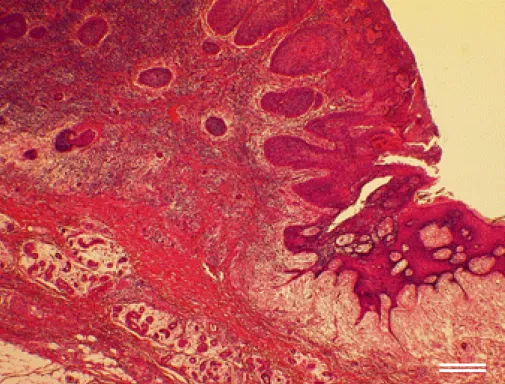 Fig. 5.   The hypopharyngeal cancer shows  exophytic growth from the skin flap  (hema-toxylin and eosin)