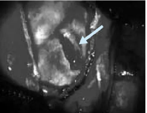 Fig.  4.    Excised  specimen.    The  perforating  wound  caused by the knife (arrow).
