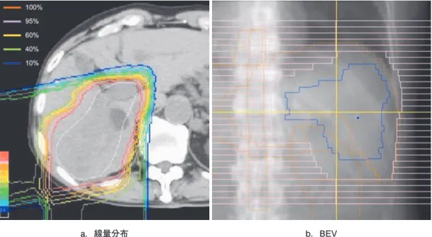 図 1 肝後区域に発生した肝細胞癌（ 6 cm ）および門脈腫瘍栓（ Vp3 ）に対する陽子線治療例